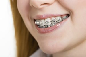 The Issues Caused by Crooked Teeth 