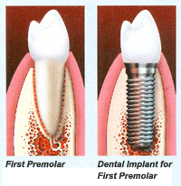 dental implants