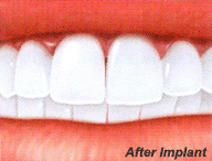 dental implants and veneers