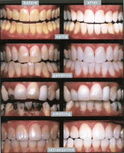 foods to whiten teeth and prevent staining