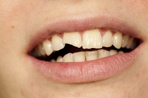 4 Ways to Treat Broken Teeth