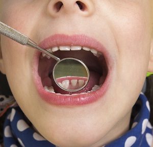 Cavities: How to Treat Them