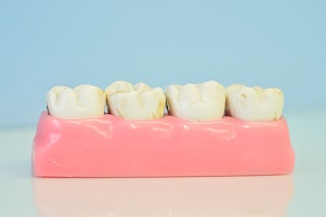 5 Benefits of Porcelain Veneers For Your Health