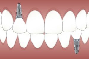 A Closer Look at Cosmetic Dental Implants