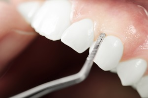 Dealing With Gum Disease: Scaling and Root Planing