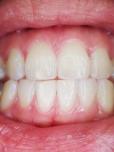 Ask Your Annapolis Dentist: Why Do I Have a Swollen Gum Around One Tooth? 