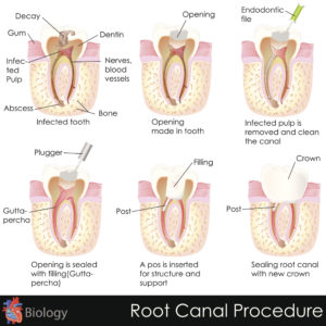 Common Root Canal Myths You Shouldn’t Believe