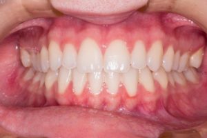 4 Tips to Maintain Healthy Gums annapolis dental care