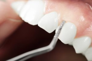 Annapolis Dental Care gum treatments dentist in Annapolis