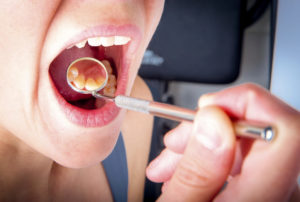 annapolis dental care tooth extraction