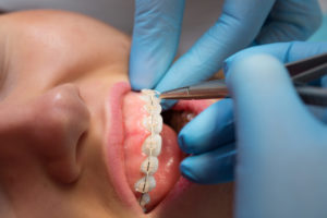 annapolis dental care cosmetic dentistry