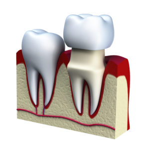 annapolis dental care Smile Benefit from Having Dental Crowns