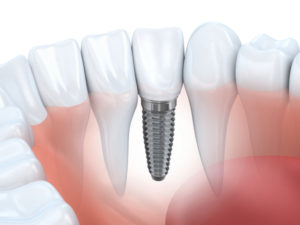 annapolis dental care replacing missing teeth