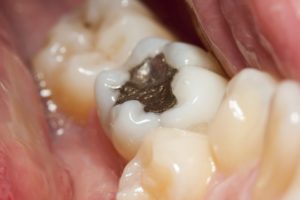annapolis dental care restorative dentistry