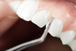 Annapolis Dental Care Gum Treatments Dentist in Annapolis