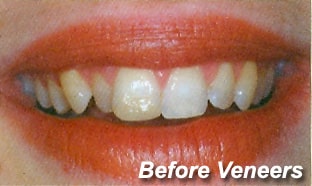 Before Veneers