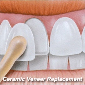 Ceramic Veneer Replacement