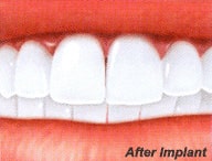 Implant After