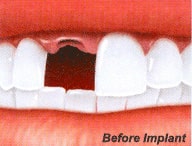 Implant Before