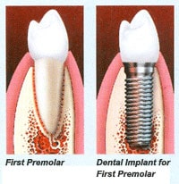 Implant