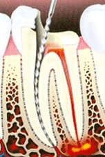 Root Canal Procedure 2