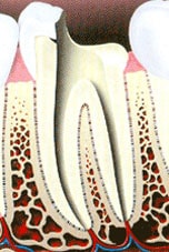 Root Canal Procedure 3