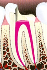 Root Canal Procedure 4