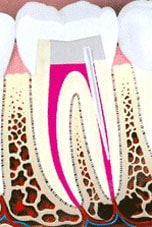 Root Canal Procedure 6