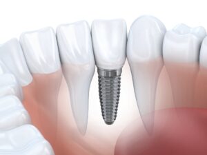annapolis dental care dental implants