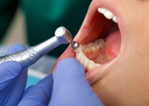 Disadvantages and Advantages of Deep Cleaning Teeth