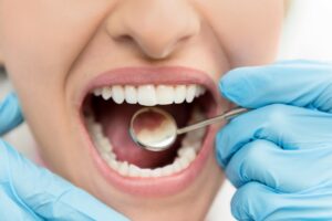 annapolis dental care new dental crown