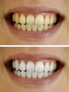 annapolis-dental-care-tooth-discoloration