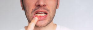 annapolis dental care Periodontal Disease